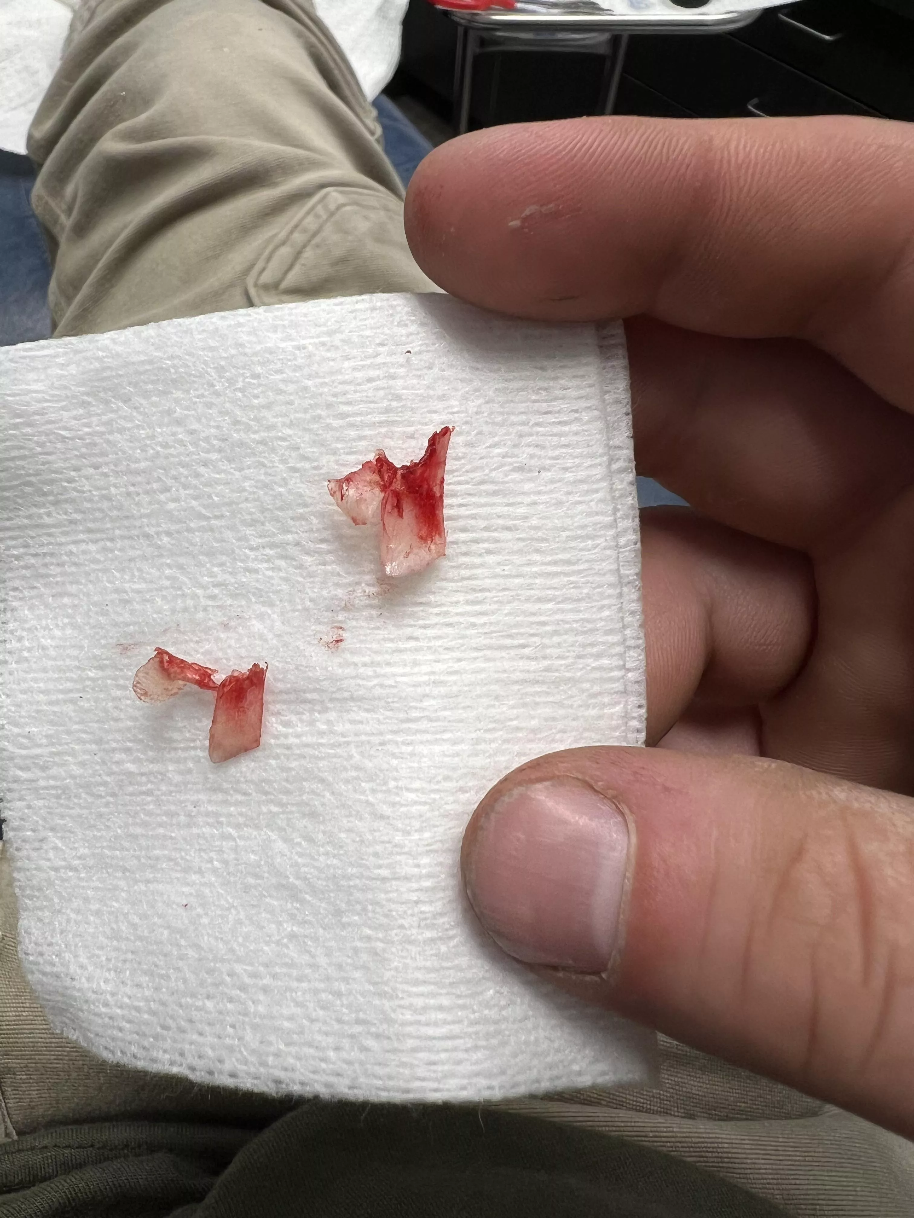 Ingrowns I had removed today posted by JD3220