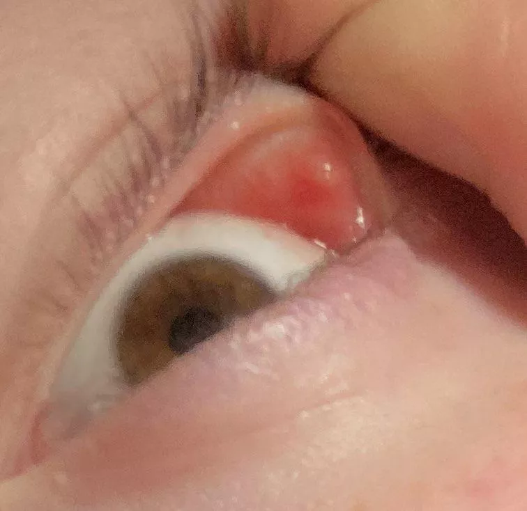 Potential eye pimple? posted by Individual_Matter_67
