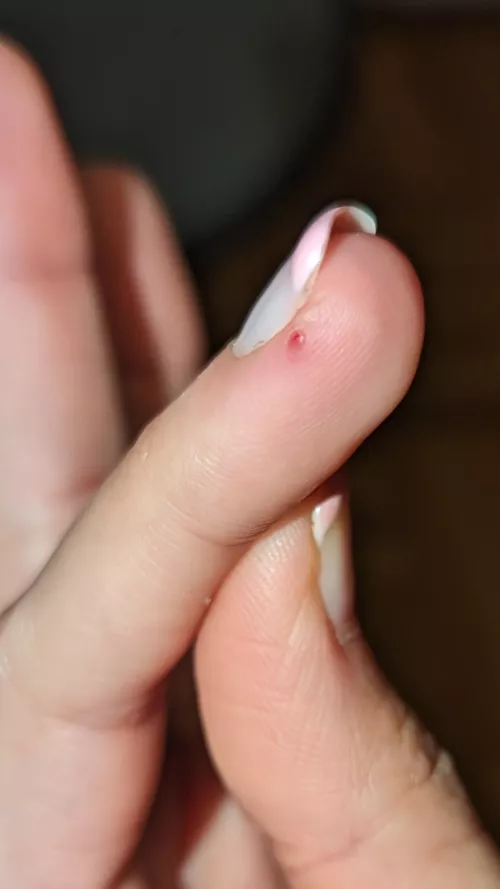 Had this thing on my finger for a while, it was always red, but it just popped, any idea what it could be? by ZarkMukurberg