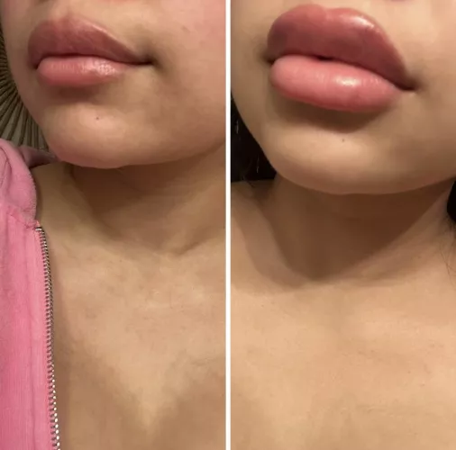 Lip filler progress! Can’t wait for more by xojustbri