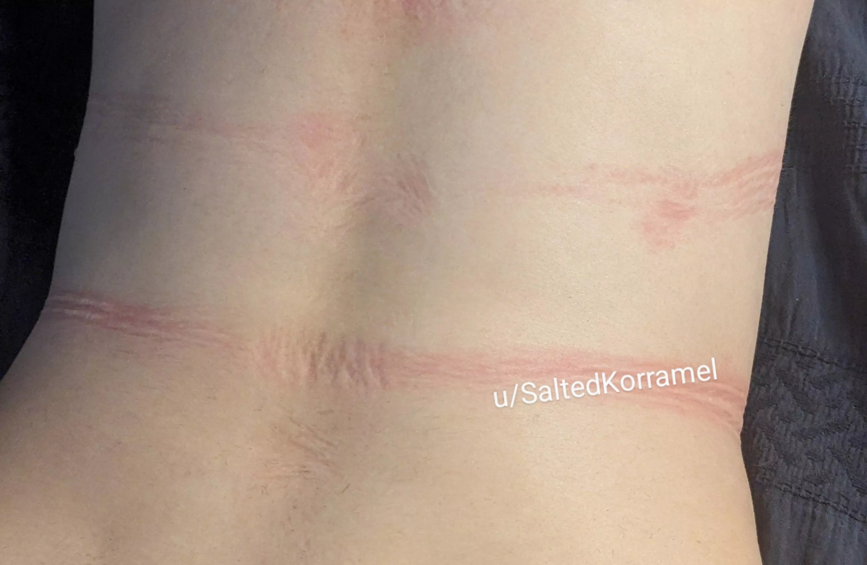 Some of the rope marks on my back 🖤  posted by SaltedKorramel