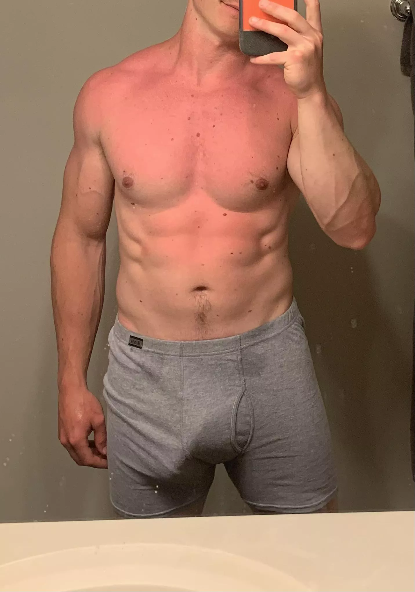 Accidentally got burned by the pool (29) posted by Midwest678