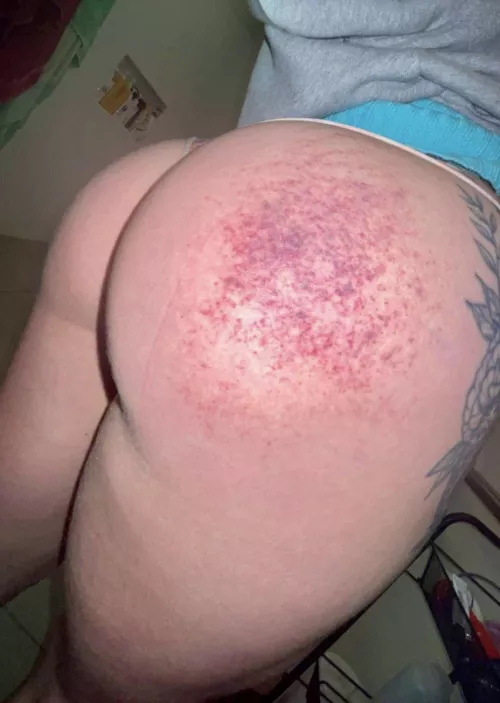 Bruising is coming up real nice 🥰 by Prestigious-Car-2536