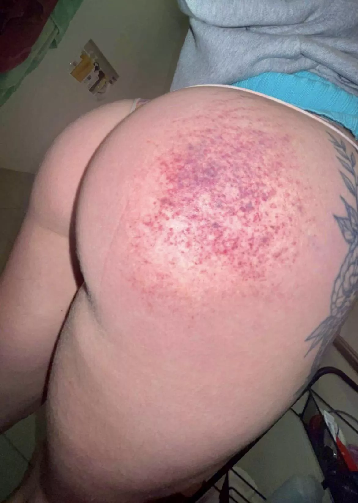 Bruising is coming up real nice 🥰 posted by Prestigious-Car-2536