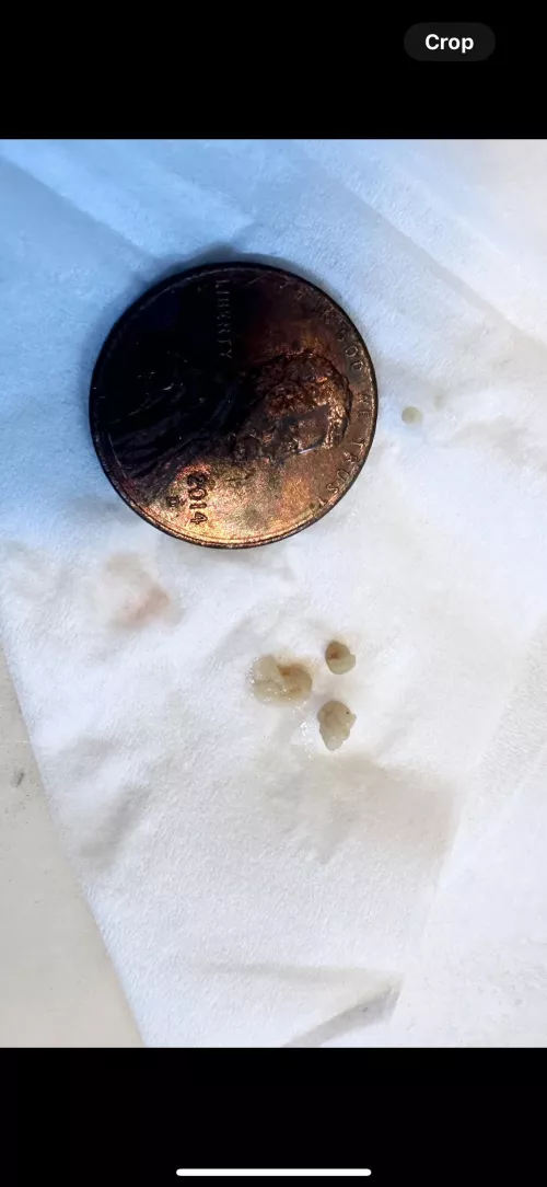 Tonsil stones FINALLY came out! by The_Grossest