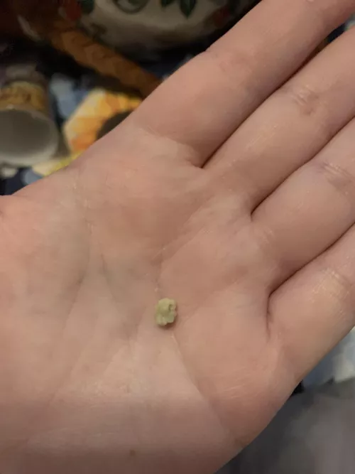 My biggest tonsil stone ever by suicidesluttt