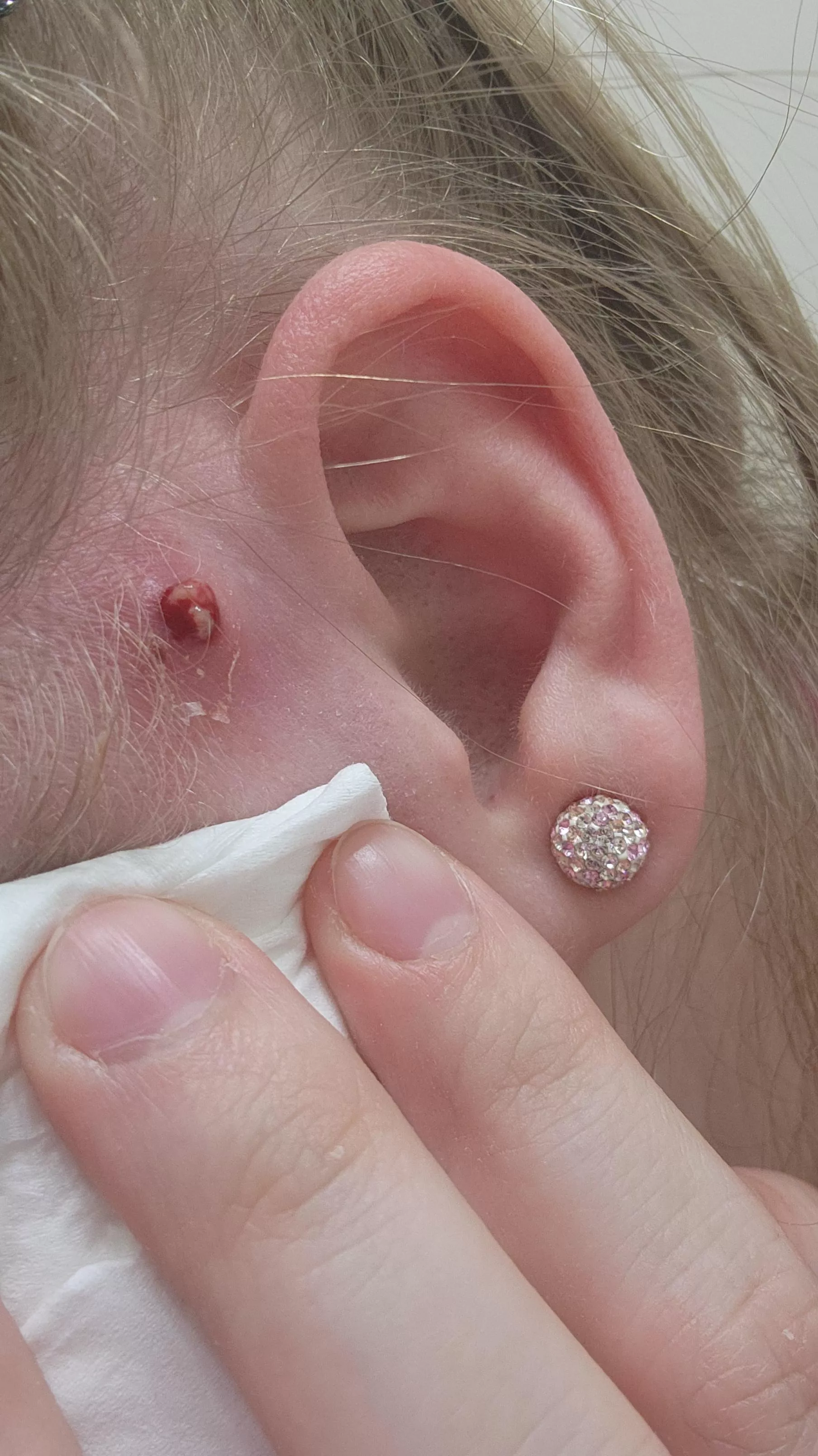 Well guess my MRSA came back again, she is angry 😅 posted by blondegirly23