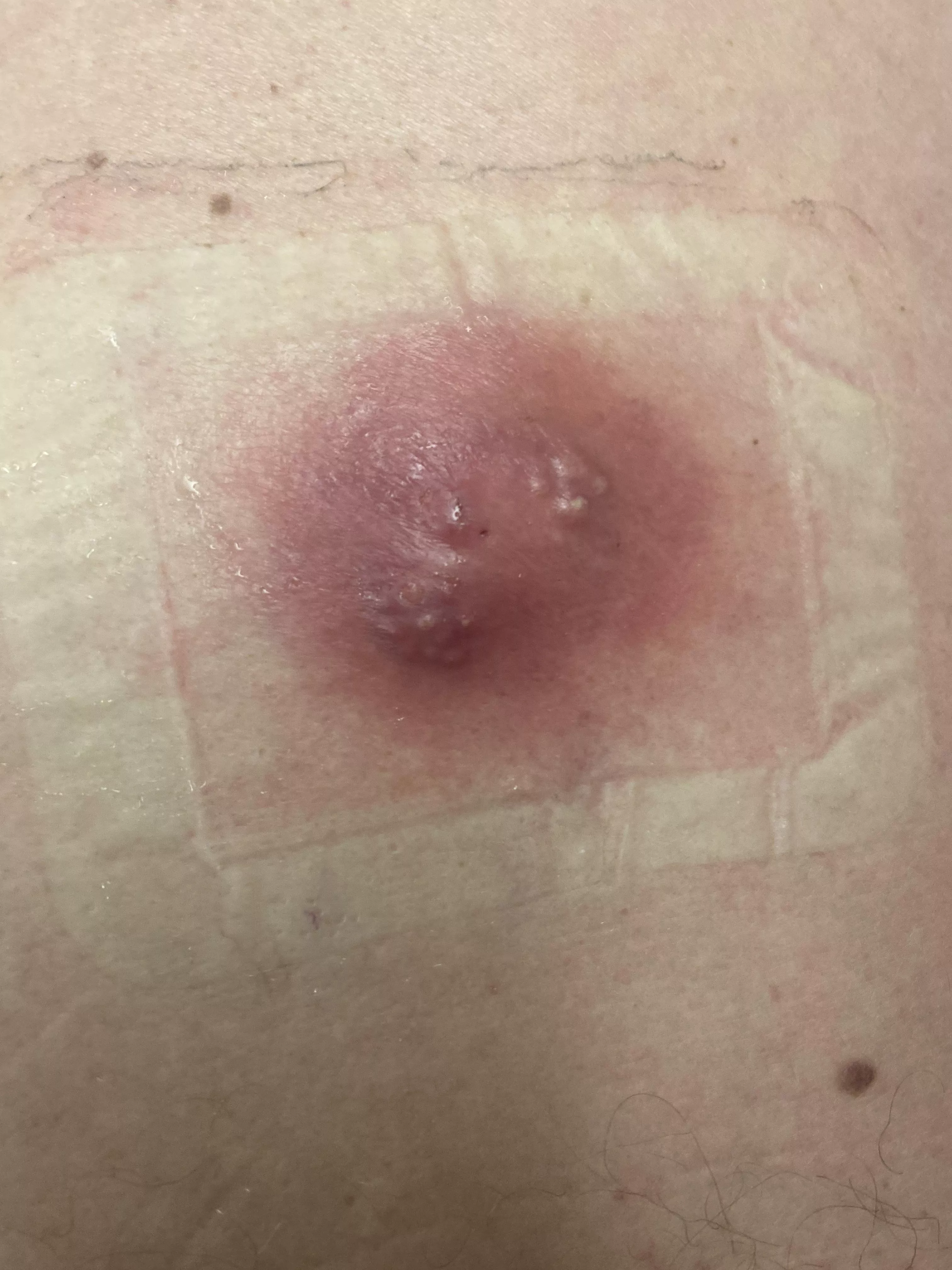 Infected cyst/abscess on my Dads back (taking 10 days antibiotics before they lance it) posted by failedabortedfetus