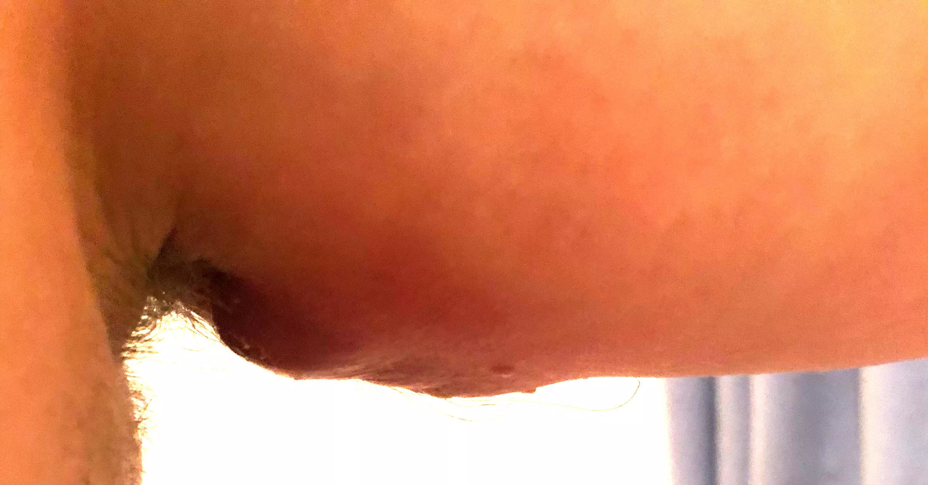 Pic of my painful boil that a surgeon will hopefully drain today posted by DontHasAReddit