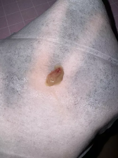 Coughed up this mucus plug. I feel like a whole new person and finally got my voice back by chaoticjane