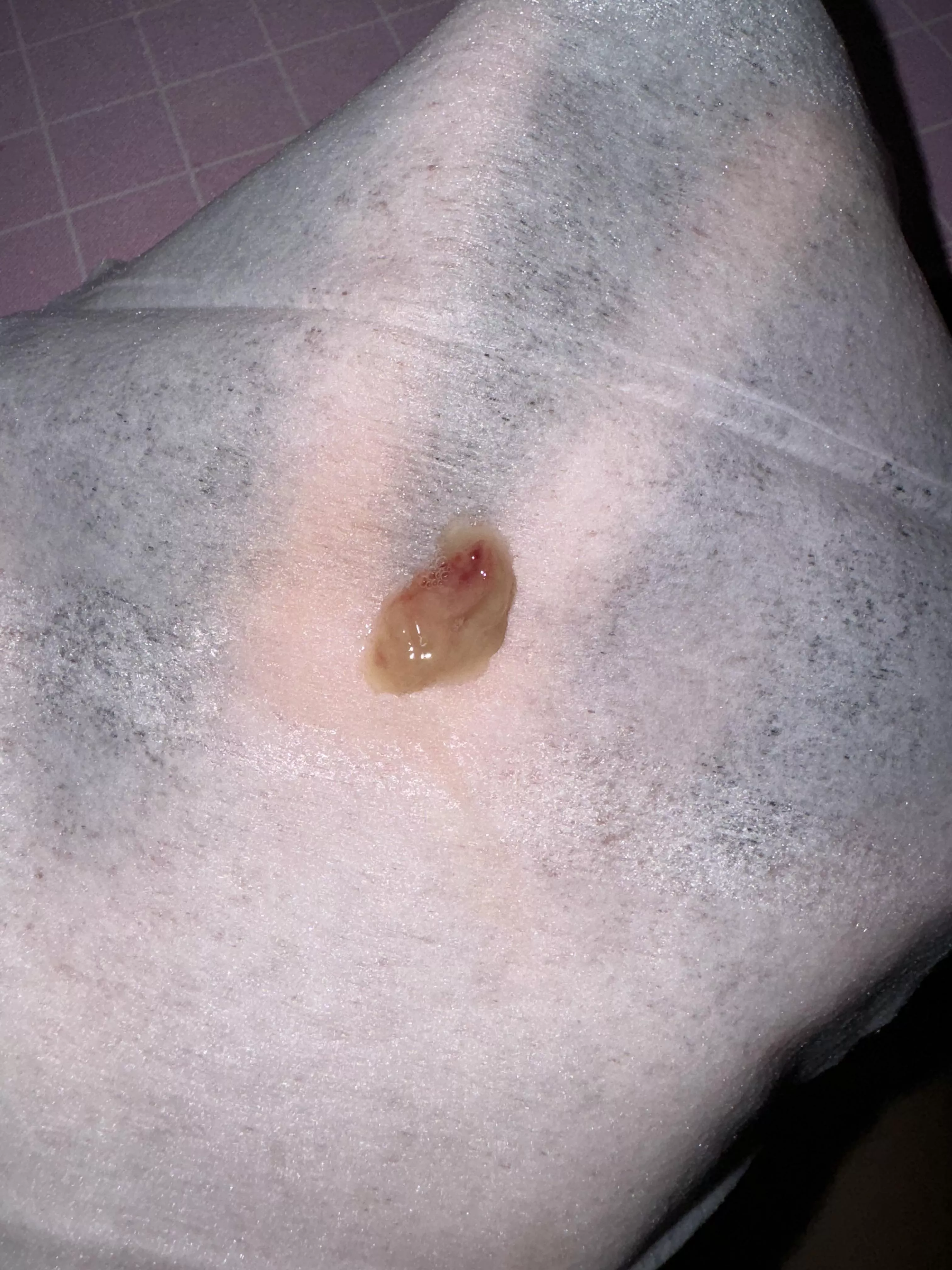 Coughed up this mucus plug. I feel like a whole new person and finally got my voice back posted by chaoticjane