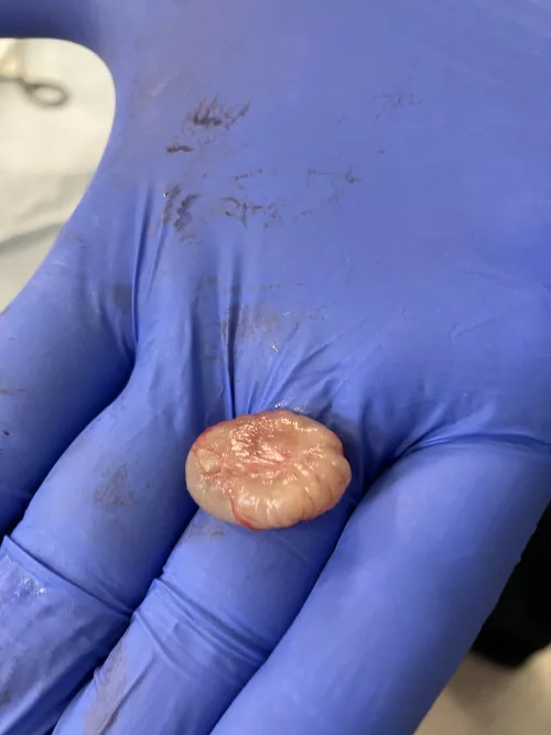 Cyst removal - scalp by hob92