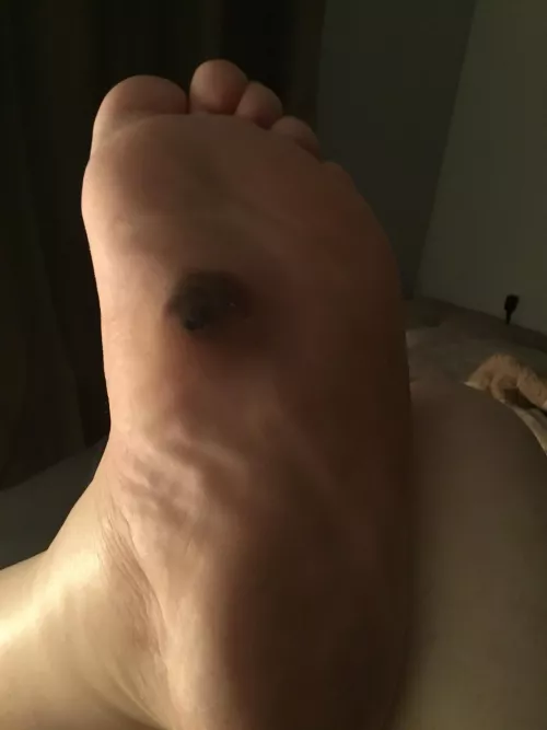 Want to pop - blood blister on top of cyst by texaspoet