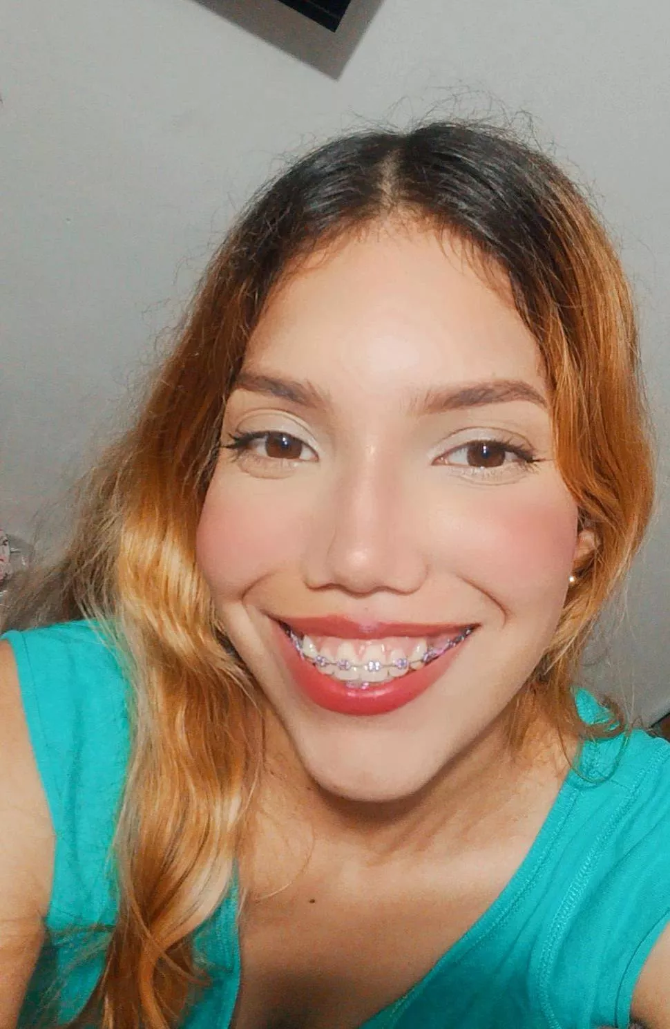 My braces are now a pretty lilac color. posted by Camiipie