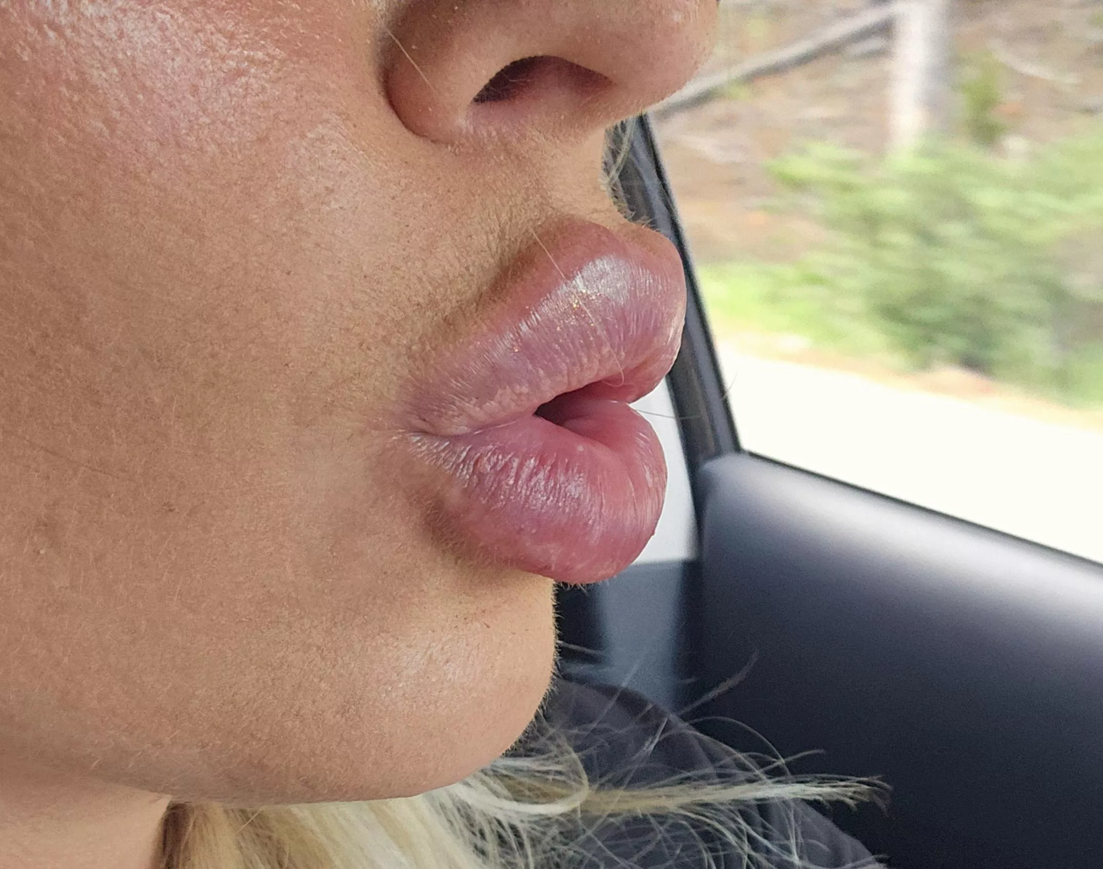 thick filler lips posted by FeistyAbalone7644