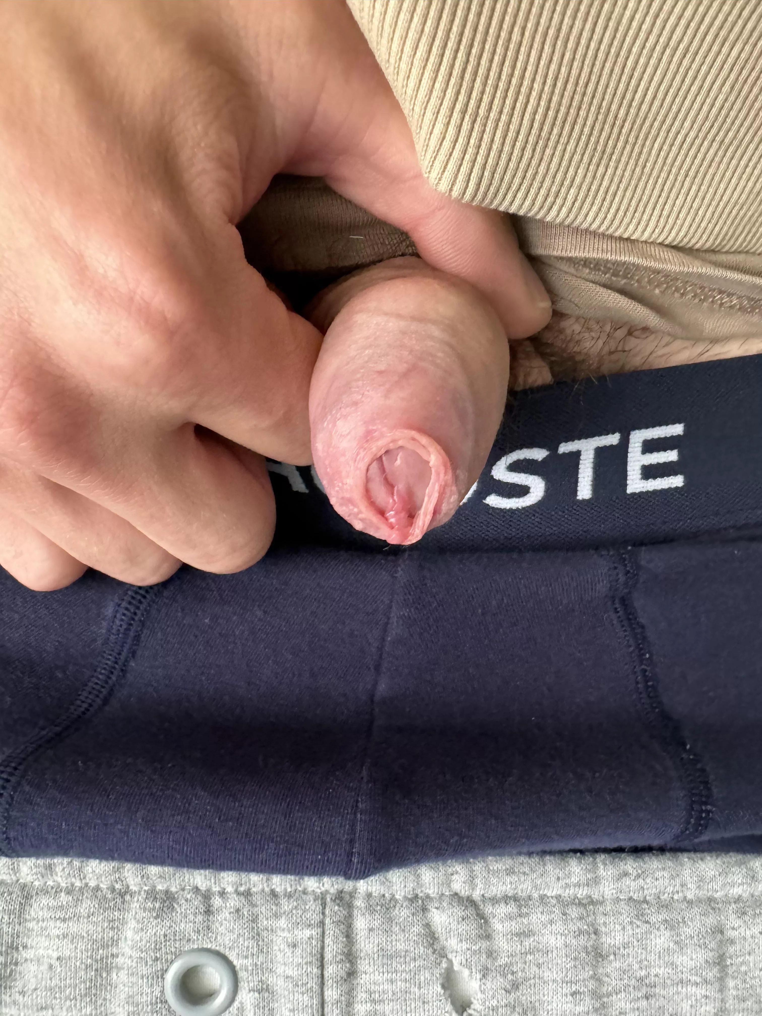 Phimosis, short Frenulum issues please help or advise! Will stretching help?  posted by Traditional-Sale-157