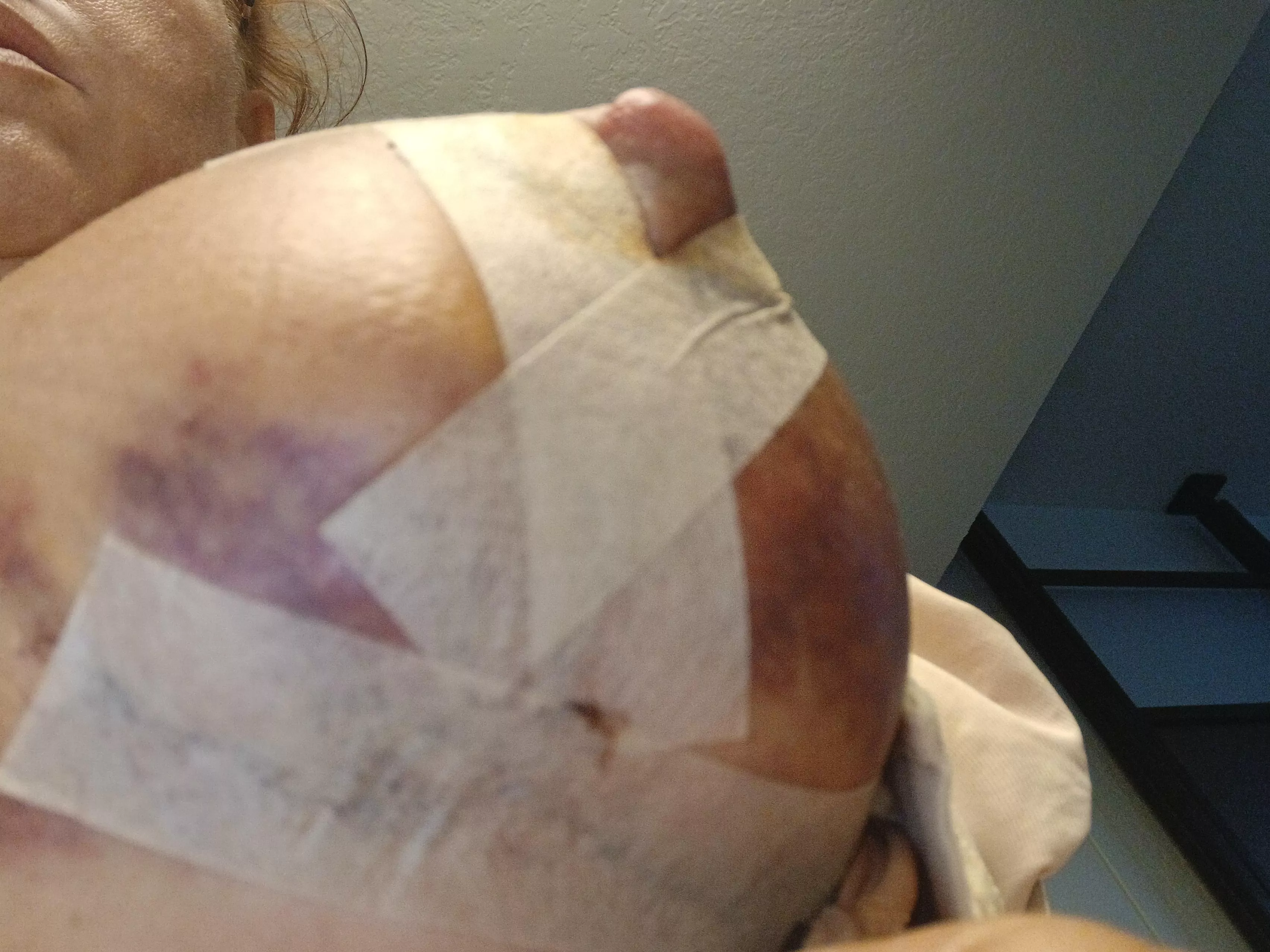I have some nipple necrosis now im seeing this under boob , normal brusing? posted by Wildflower_035