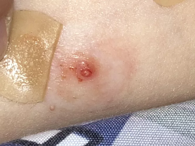 Forbidden Molluscum Pop by Ok_Frosting_5911