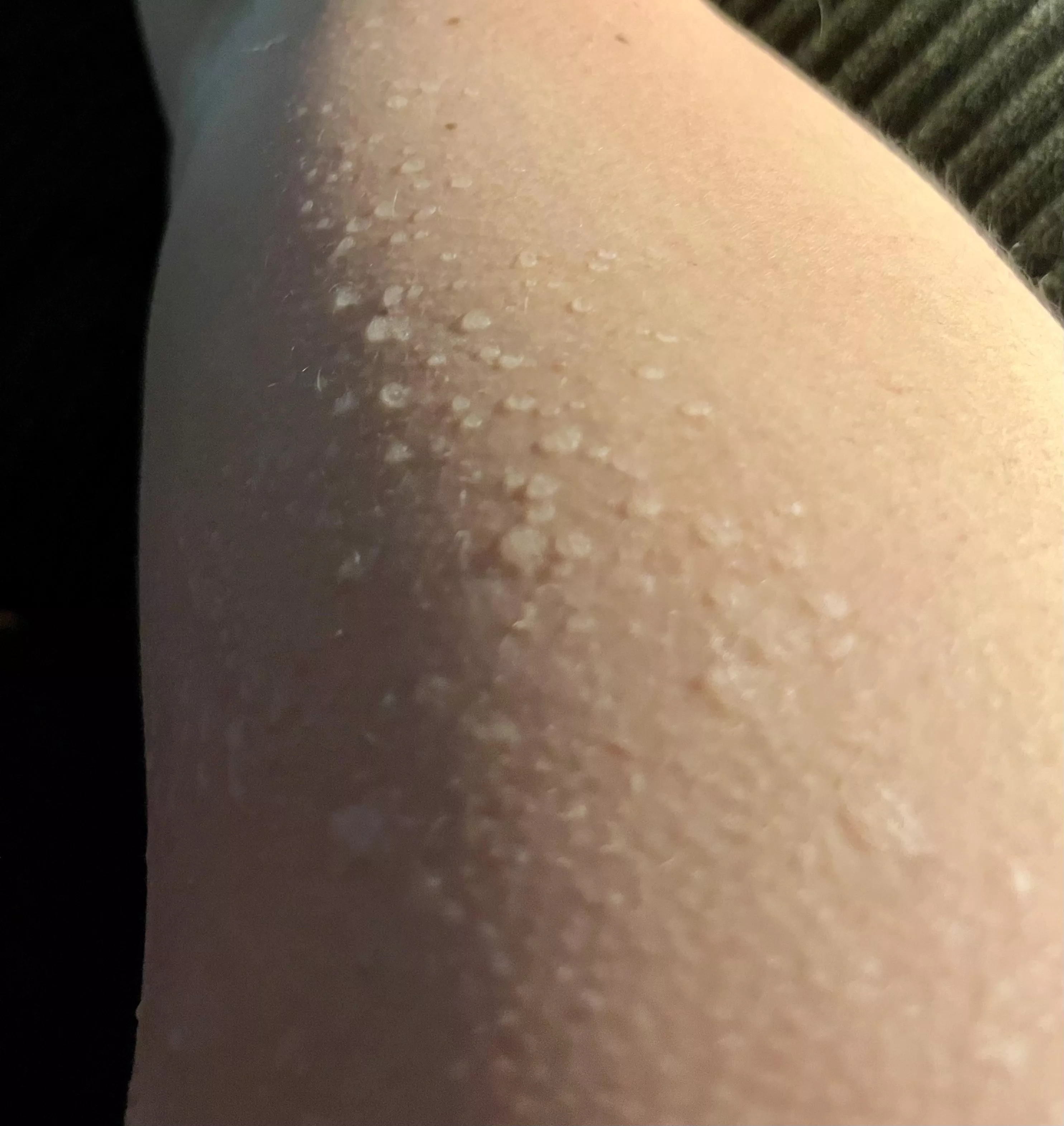 Sweating after a sunburn leads to the worst bubble wrap  posted by lorinisapirate