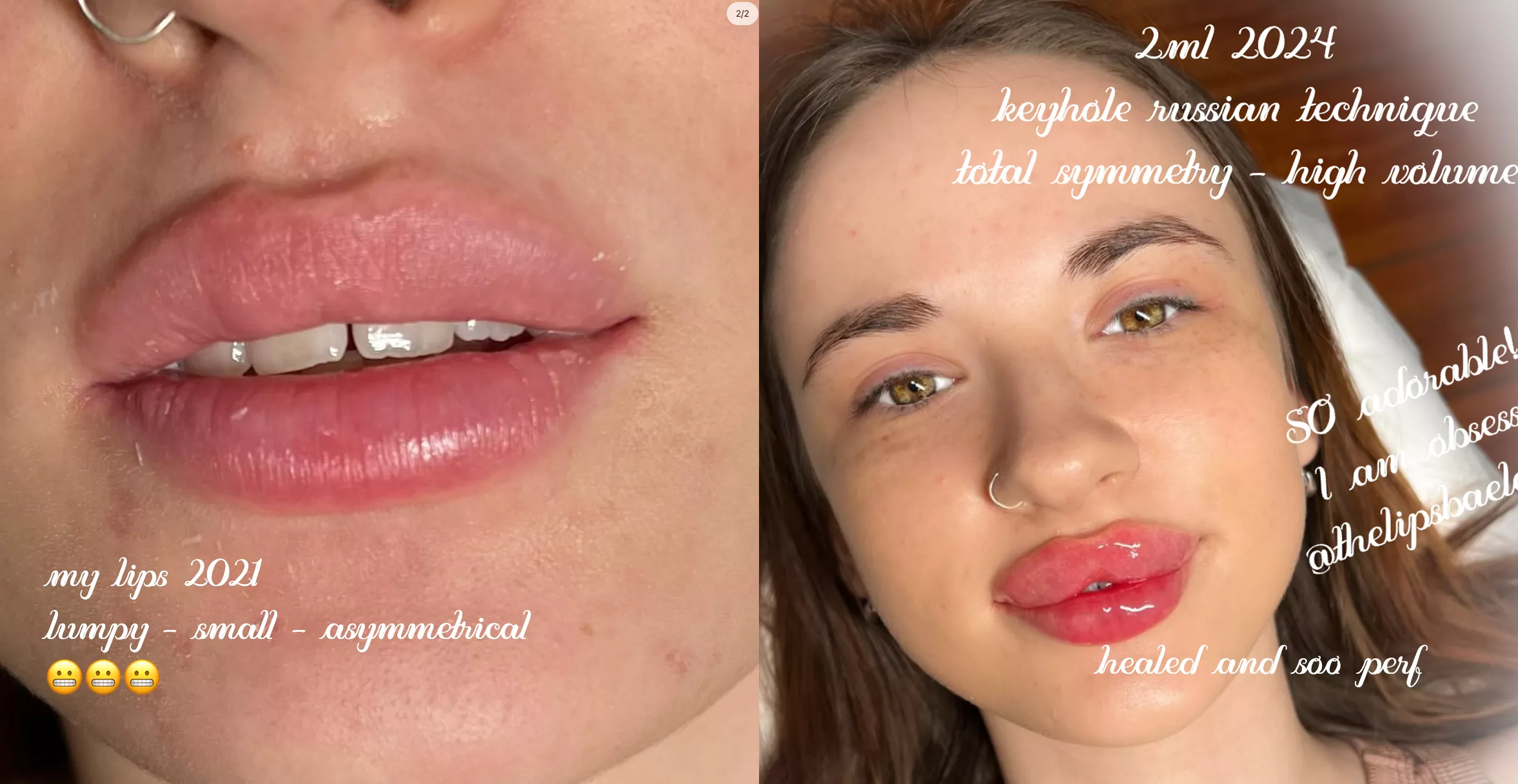 Lip filler influencer on IG posted by anonyyyymuser