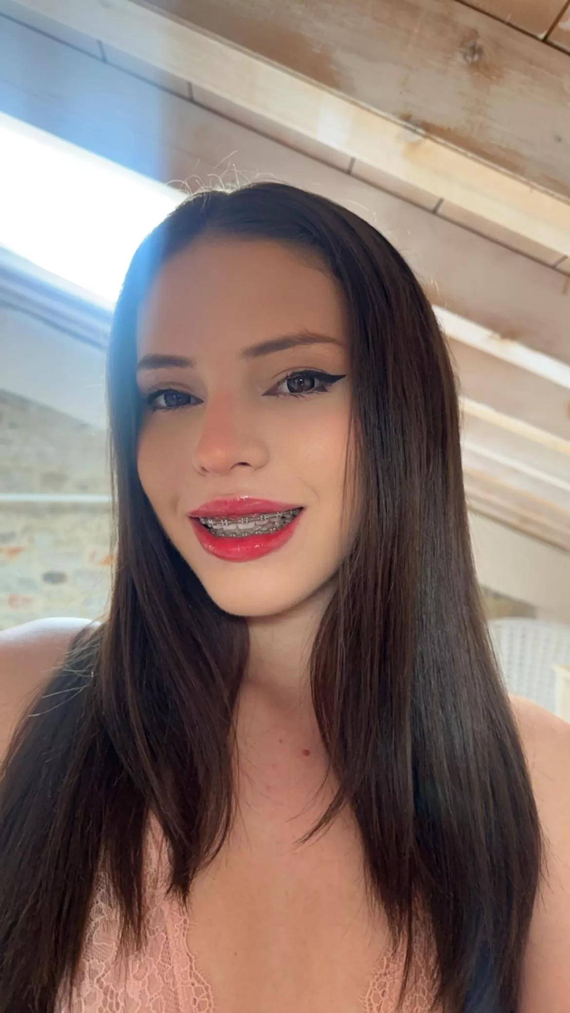 Hi there! New braces for me!  posted by alestarz