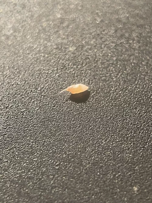 Pulled this out of my face. I thought it was a new psoriasis nodule, but no, ingrown hair by CheopsII
