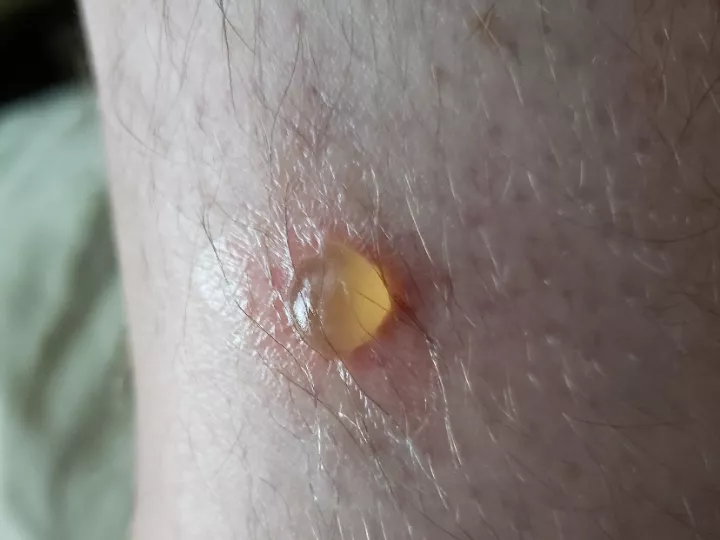 Chigger blister on ankle posted by holesofdoubt