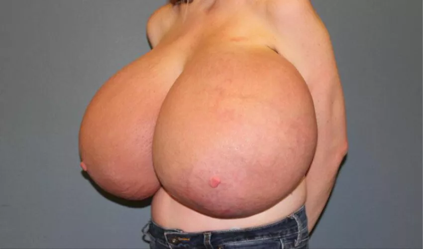 Poor girl ballooned six cup sizes in a week by [deleted]