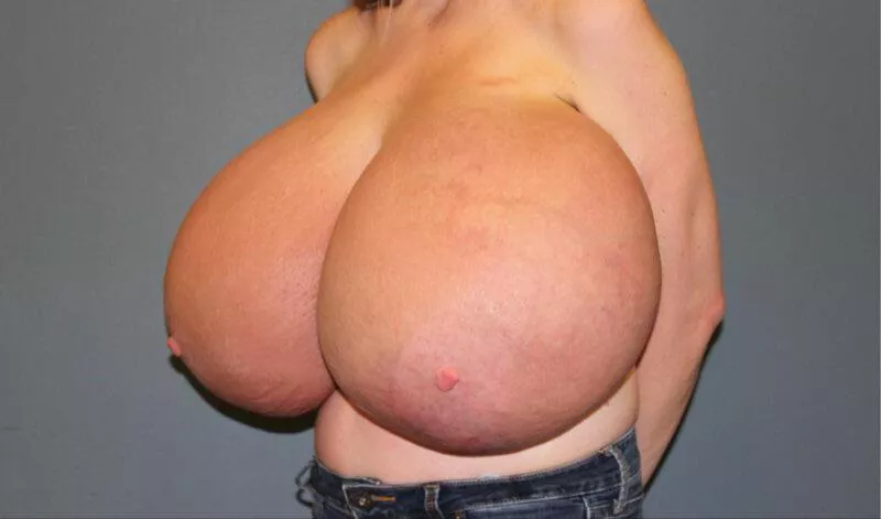 Poor girl ballooned six cup sizes in a week posted by [deleted]