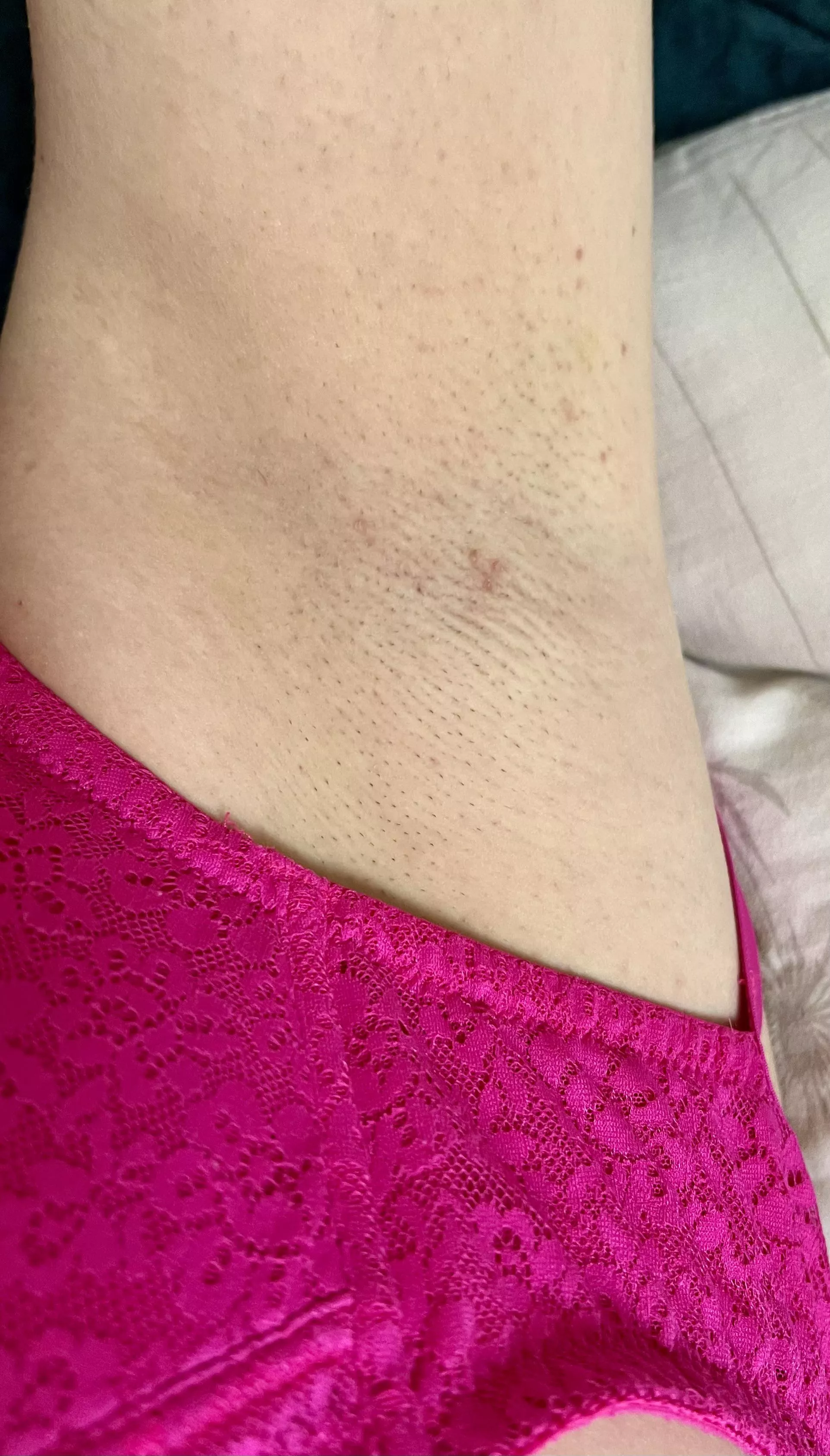 Prickly. Should I shave? posted by sunnypits