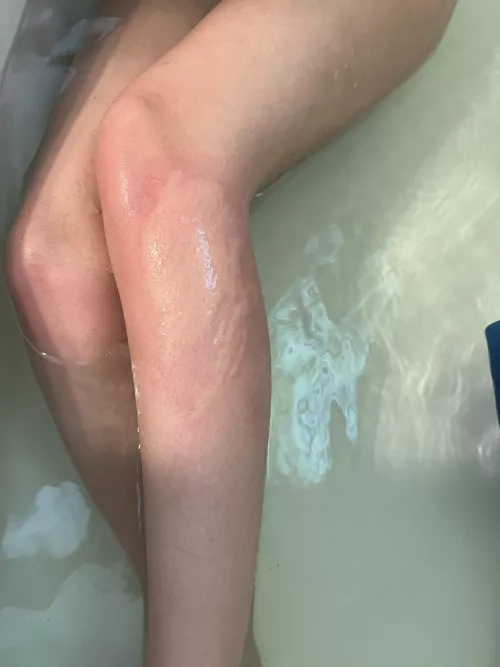 Stung by something in the ocean burning shooting pain any thoughts what it could of been by National-Fun-4342