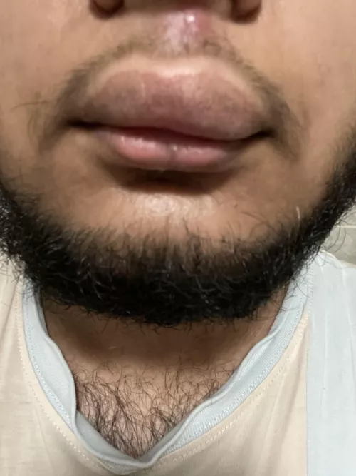 Popped a pimple on my lip and now it looks like this by Infernester