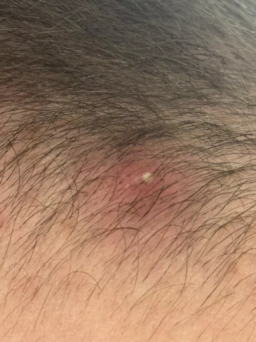 Beautiful Ingrown on my head I’ll record for ya’ll soon by Finn_Bird