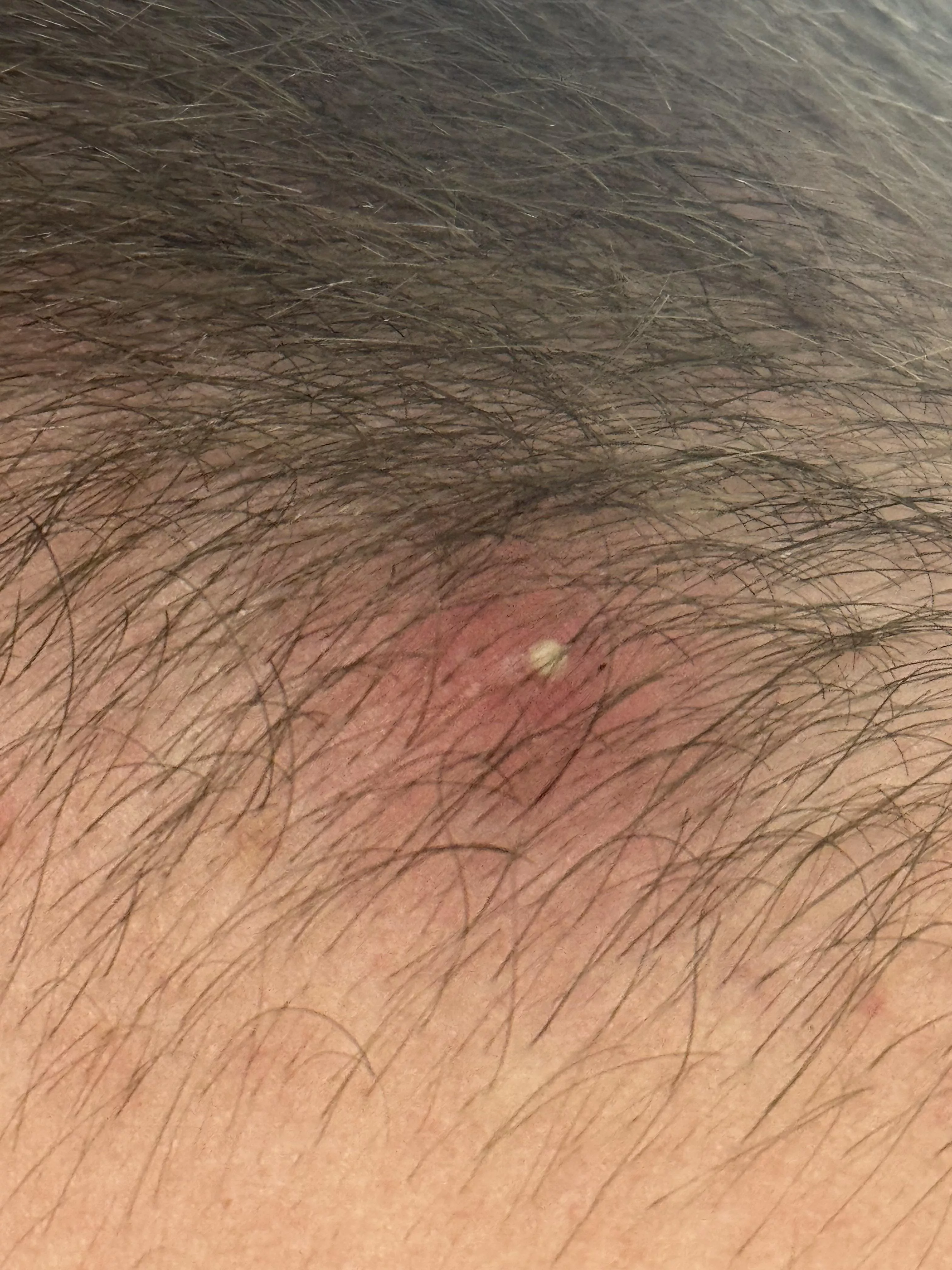 Beautiful Ingrown on my head I’ll record for ya’ll soon posted by Finn_Bird