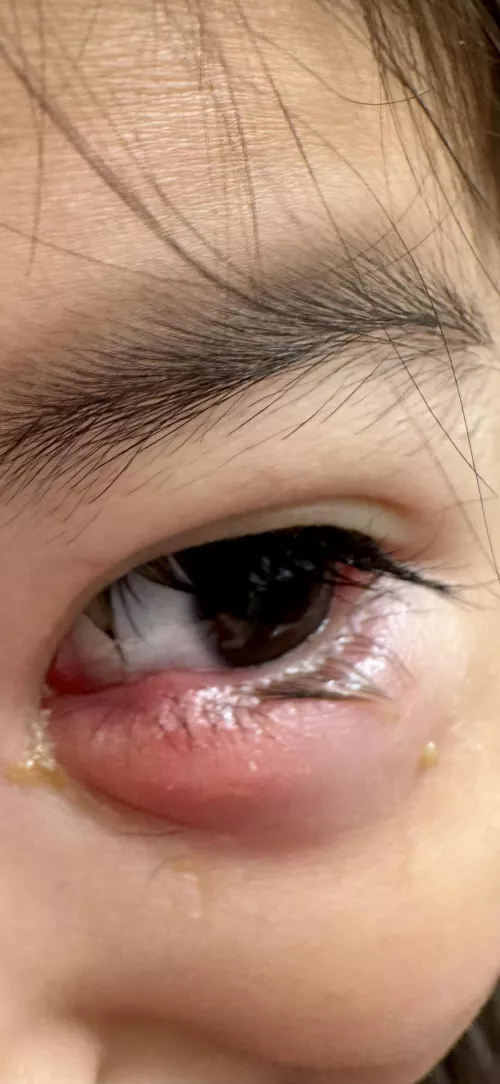 My 3yo’s infected stye. Forbidden pop (obviously)! by OutlanderHealer