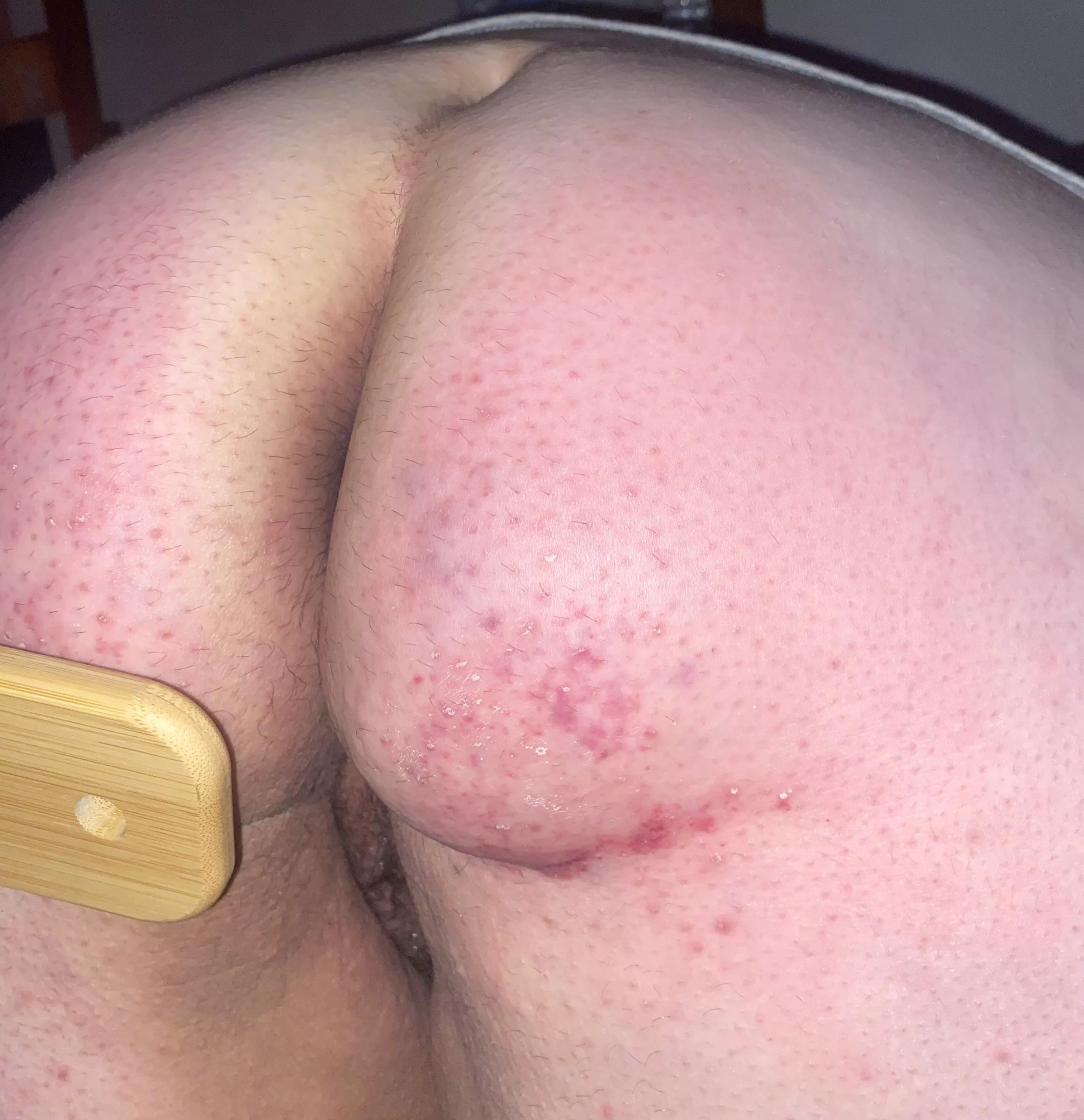 ouchie :(  posted by slynn01