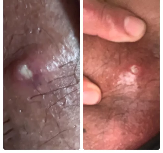 I think I messed up by popping this  by Competitive-Loss8218