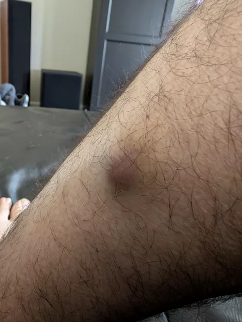 Not sure what this is. Has been on my leg for a couple of years or so. Hasn't gotten larger in a year. I really want to pop it but I instead made an appointment with the dermatologist. I'll try to get footage or poppage! by ECapo10