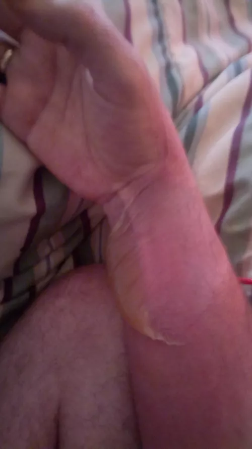 Forbidden pop, radiator burn (OC) by FriendshipCautious73