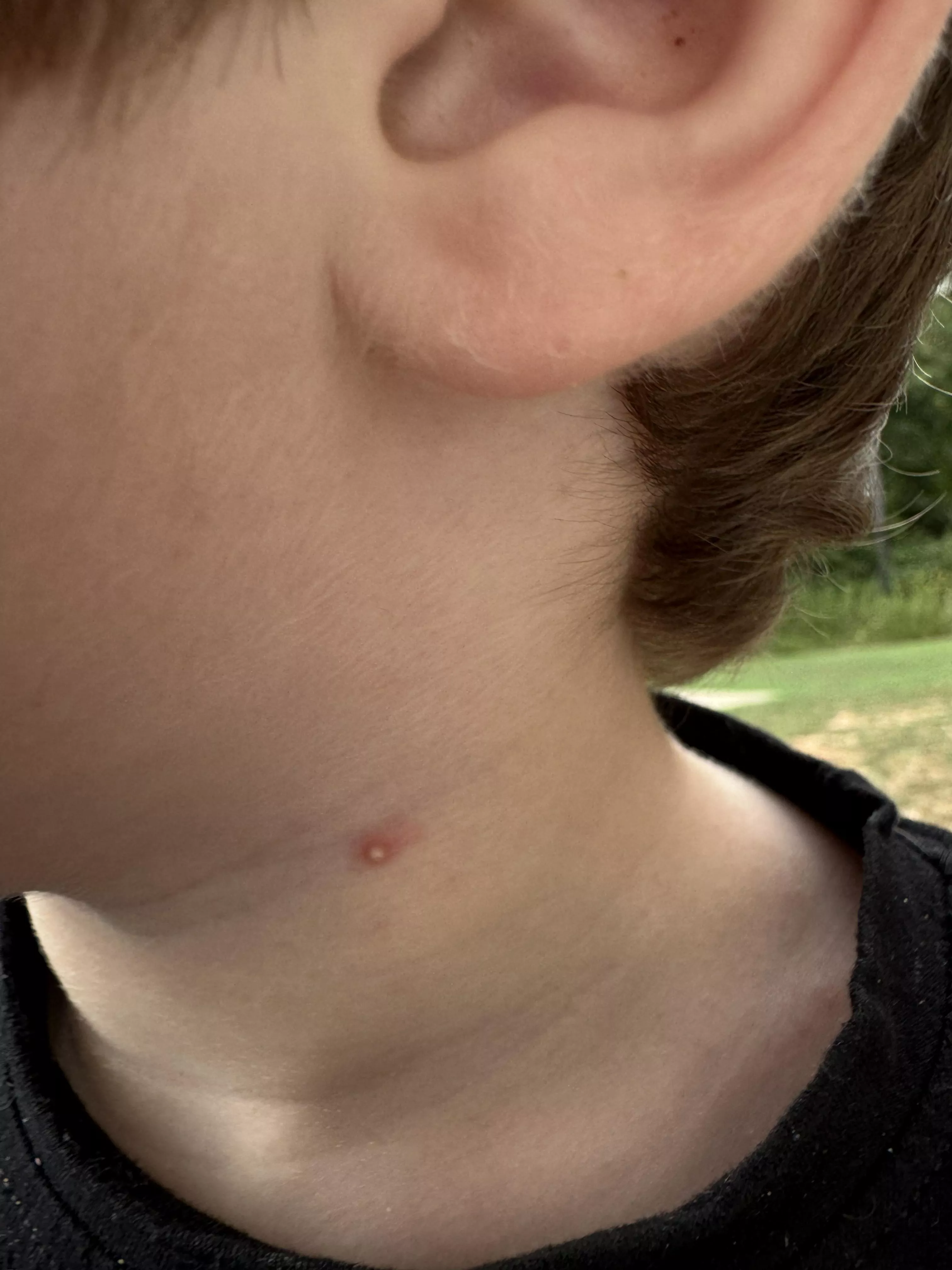Forbidden pop, this popped up on my 2 year olds neck.  posted by Cjd2x