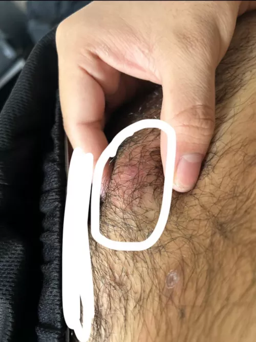 Hard lump on pubic area, it hurts when I touch it too hard or when I wear tight clothing, had for like a day or 2 and I think I’ve gotten these before but never really knew what it is, how it’s caused, and how to get rid of them, if anyone could info by ceaser2sexy