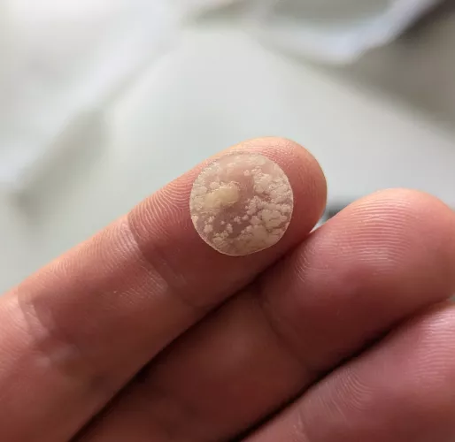 [PIC] My hydrocolloid patch after 3 hours on my aggressive face zit by feeblegut