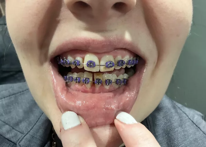 Thread to show my progress: 2 months and purple :3 by RebecaClarkBigAss