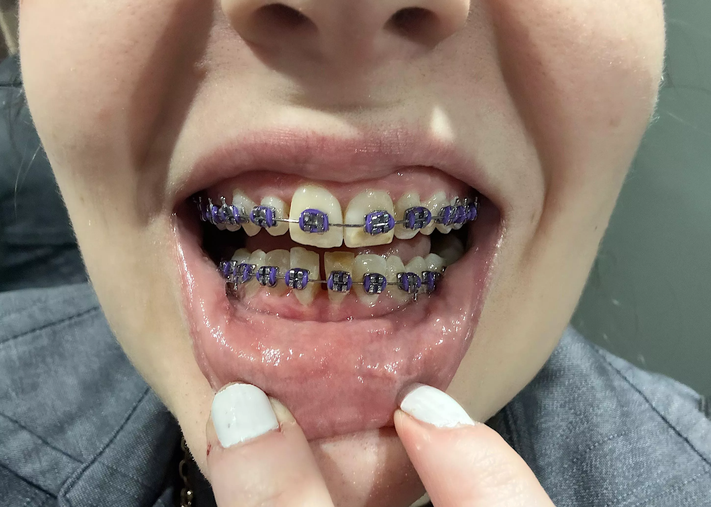 Thread to show my progress: 2 months and purple :3 posted by RebecaClarkBigAss