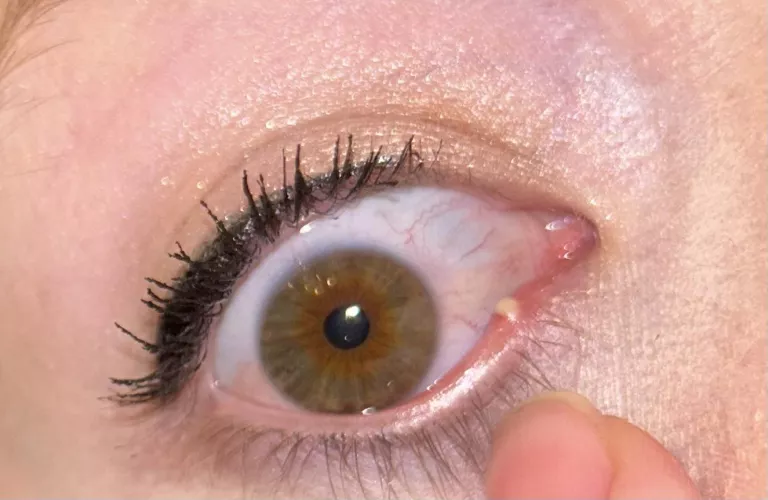 Stye… to pop or not to pop 😅 by Infamous-Ad-4860