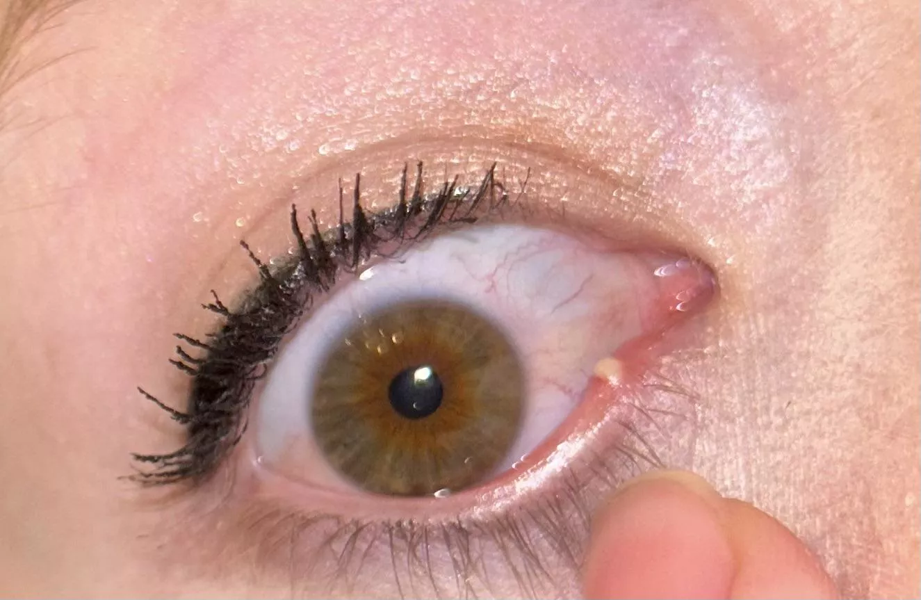 Stye… to pop or not to pop 😅 posted by Infamous-Ad-4860