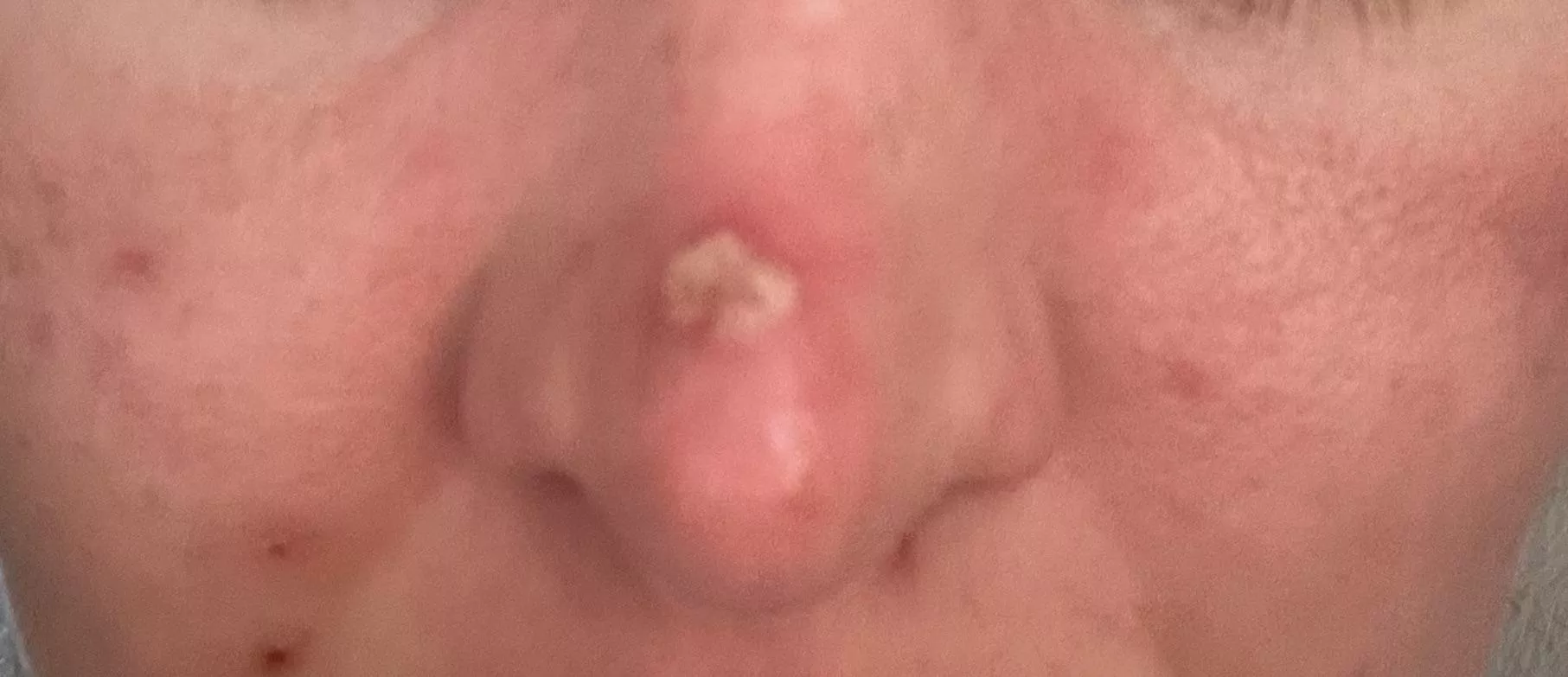 Forbidden pop from skin infection. It took every ounce of willpower not to pick this  posted by blondebumpkin