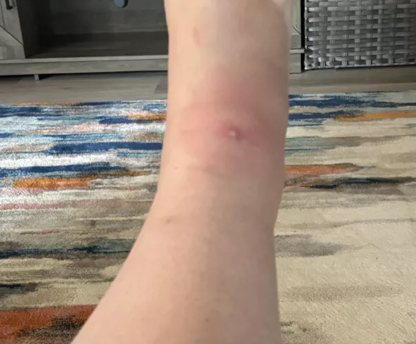 An ant got me and I’m sad it’s a forbidden pop by definitelygrouchy