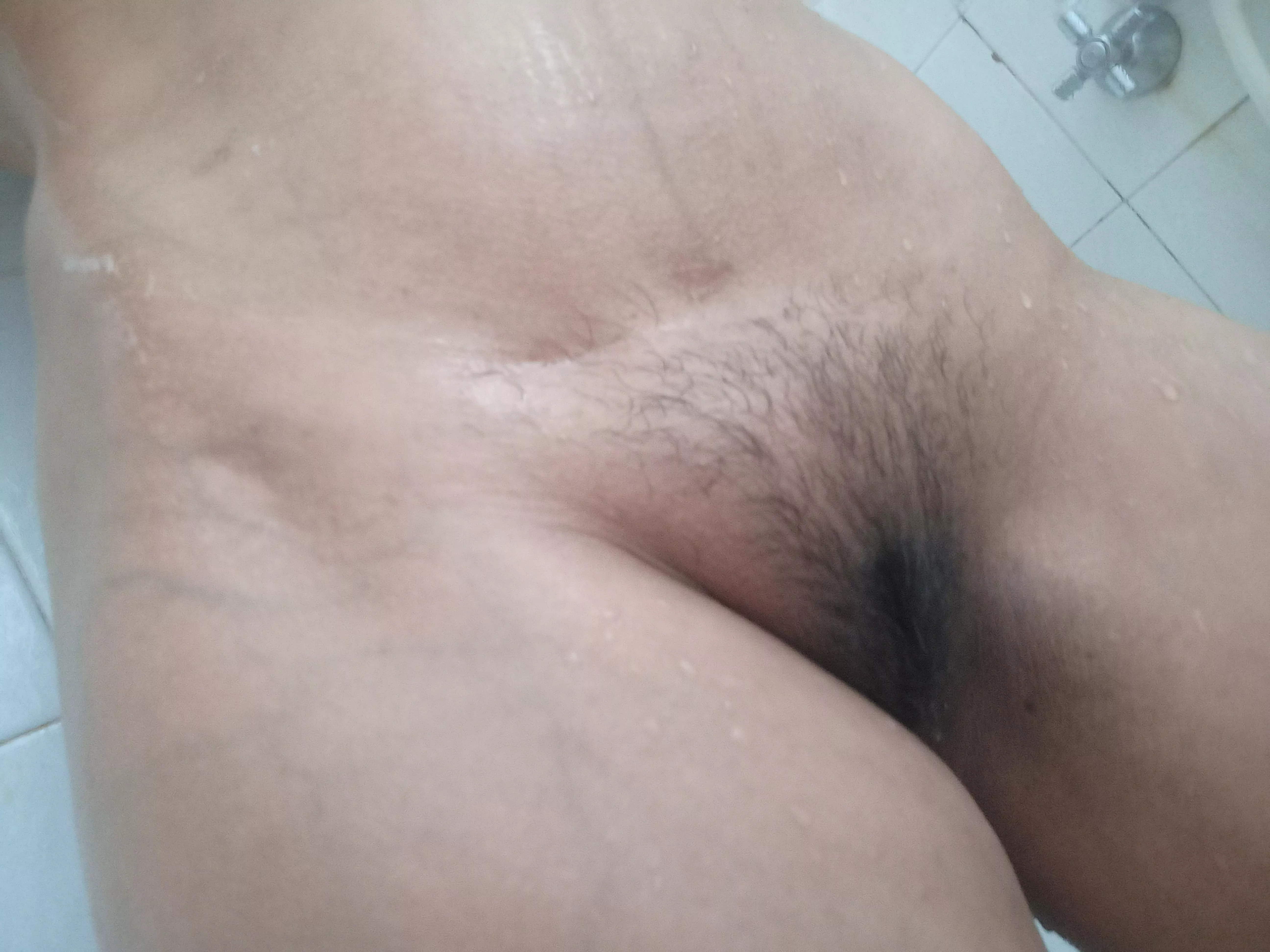 Caesarean scar posted by SugarSirenx