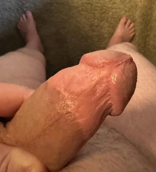 Had mine removed at 21 by NeverLetMeCum95